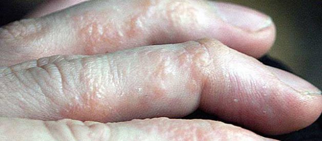 Eczema Natural Remedies: Use an Alternative Atopic Dermatitis Treatment to Heal Itchy Skin