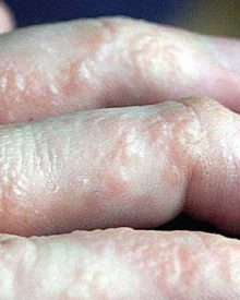 Eczema Natural Remedies: Use an Alternative Atopic Dermatitis Treatment to Heal Itchy Skin